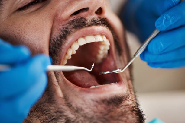 Best Emergency Tooth Extraction in Runge, TX
